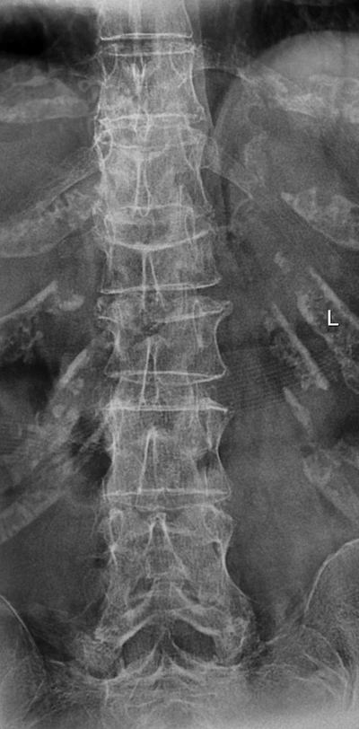 raggi colonna vertebrale